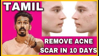 REMOVE ACNE SCAR IN 10 DAYS  TAMIL  HOUSE OF MAVERICK [upl. by Nylkcaj958]