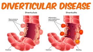 Diverticulosis And Diverticulitis [upl. by Adnhoj]