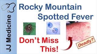 Rocky Mountain Spotted Fever  Bacteria Signs amp Symptoms Diagnosis and Treatment [upl. by Eirhtug]