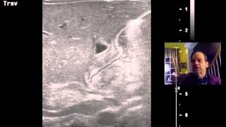 Pyloric Stenosis Ultrasound DISCUSSION 1 [upl. by Innoc]