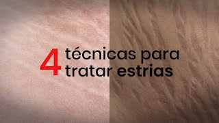 4 técnicas para tratar estrias [upl. by Htebazie555]