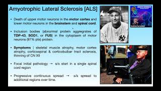 Amyotrophic Lateral Sclerosis ALS  Basics amp Clinical Presentation [upl. by Pulsifer577]