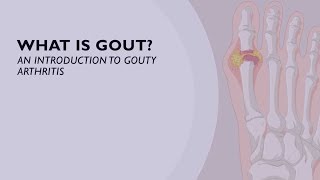 Acute Gout Treatment  How You Can Relieve the Sudden Onset of Pain 5 of 6 [upl. by Niboc]