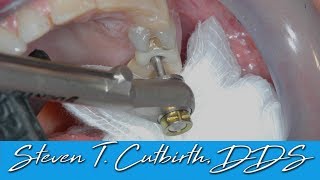 Loose Implant Screw  Dental Minute with Steven T Cutbirth DDS [upl. by Doloritas312]