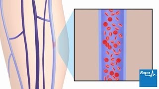 DEEP VEIN THROMBOSIS How To DIAGNOSE amp TREAT Venous Diseases [upl. by Richela]