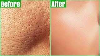 How To Get Rid Of LARGE PORES PERMANENTLY 100 Works Shrink amp Get Clear Glass Skin Naturally [upl. by Buffum655]