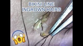 Satisfying Bikini Line Ingrown Hairs Microscopic [upl. by Aran462]