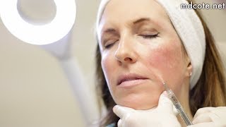 Full Face Rejuvenation with Hyaluronic Acid Fillers [upl. by Eedoj]