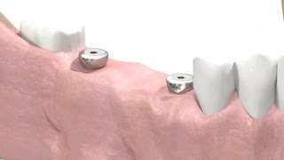 SIC invent Dental Implant  Prosthetic Animation BridgeWork Open Tray Technique [upl. by Ahseiyt567]