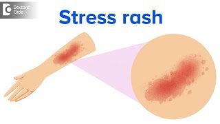 What causes Cold Hives amp how to manage it  Dr Urmila Nischal [upl. by Fancie]