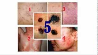 Common Skin Diseases and Disorders [upl. by Aneeres220]