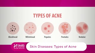 Types of Acne [upl. by Tommi]