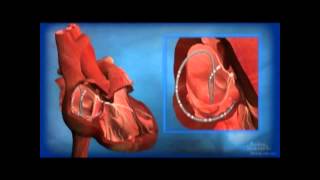 3rd Degree AV Block ECG  EMTprepcom [upl. by Phenice]