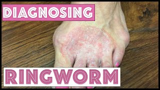 How we diagnose Ringworm Tinea Corporis [upl. by Ylremik]