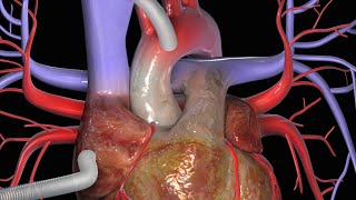 Coronary angiography procedure [upl. by Grados656]