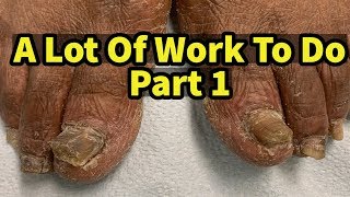 Severe Fungal Fungus Toenails A Lot Of Work To Do Part 1 [upl. by Delainey]