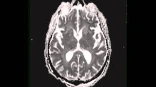 Cryptococcal meningitis [upl. by Raasch]