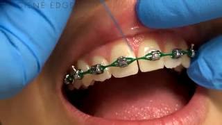 Flossing Braces With a Threader [upl. by Ellerehc]