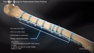 Standard polypectomy techniques Choosing the right technnique [upl. by Euell]