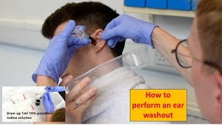 How to Perform an Ear Washout irrigation  ENTOtolaryngology Skills [upl. by Yenal]