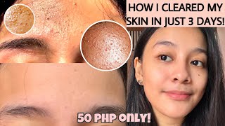 HOW TO GET RID OF TINY BUMPS ON FOREHEADFACE FAST  FUNGAL ACNE how i cleared my skin ENG SUB [upl. by Eecrad]