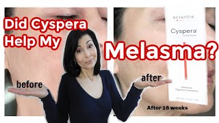 Did Cyspera® Help My Melasma My Results [upl. by Margette283]