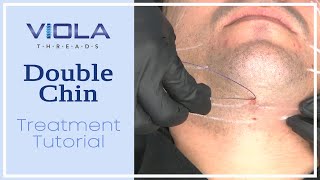 Viola Threads Double Chin Treatment Tutorial [upl. by Lotty666]