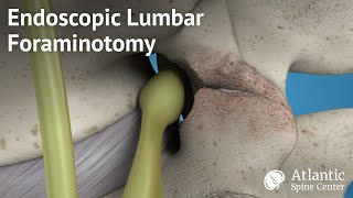 Endoscopic Lumbar Foraminotomy [upl. by Noryb]