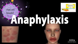 Anaphylaxis Animation [upl. by Pallas300]