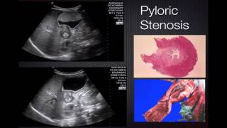 Ultrasond in Pathology  Pyloric Stenosis [upl. by Itirp]