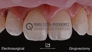 Electrosurgical Gingivectomy  Crown Lengthening [upl. by Sinnek]