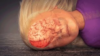 CoupContrecoup Brain Injury Animation [upl. by Yeblehs]