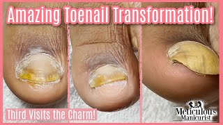 HOW TO GET RID OF TOENAIL FUNGUS AT HOME [upl. by Nedrud]