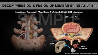 Decompression amp Fusion of Lumbar Spine at L4S1 [upl. by Cumine709]