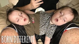 Conjoined Twins Are A Medical Miracle  BORN DIFFERENT [upl. by Zaccaria]