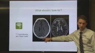 OhioHealth Multiple Sclerosis LectureUnderstanding Your MRI [upl. by Newol]