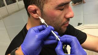 Treating Cauliflower Ear J2LATOS Long Beach [upl. by Sorgalim]