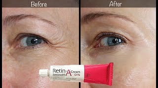 5Year RetinA Update  Before amp After for Wrinkles amp AntiAging [upl. by Krell520]