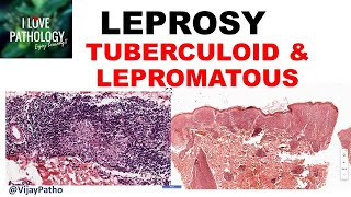 LEPROSY etiopathogenesis classification Tuberculoid amp lepromatous leprosy [upl. by Ardnyk]