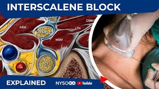 UltrasoundGuided Continuous Interscalene Brachial Plexus Block  Regional Anesthesia [upl. by Casi]