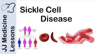 Sickle Cell Disease  Pathophysiology Symptoms and Treatment [upl. by Nhguavad760]