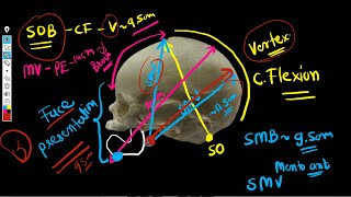 Fetal Skull Diameters  Diameters of engagement [upl. by Erlina]