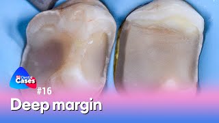 Deep margin  BG Dental Cases №16 [upl. by Launamme568]