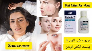 Best Acne Lotion  Dalacin T Lotion  Calindamycin 1 Acne Lotion Review [upl. by Aivlis]