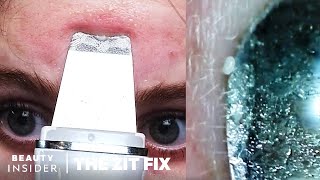 Pore Spatula Blackhead Extractions Under A Microscope  The Zit Fix [upl. by Stace]