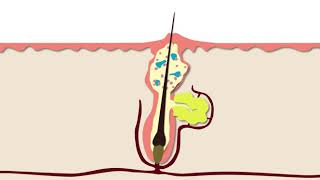 How Acne Develops  Acne Support [upl. by Gudrin210]