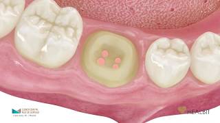 La endodoncia paso a paso [upl. by Mort]