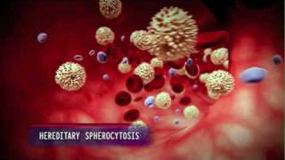 How Hereditary Spherocytosis Causes Anemia [upl. by Pattie]