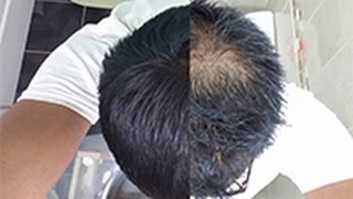 How To Use Minoxidil  Hair Regrowth  Skin Diaries [upl. by Dick]