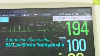 SVT or Supraventricular Tachycardia [upl. by Addam850]